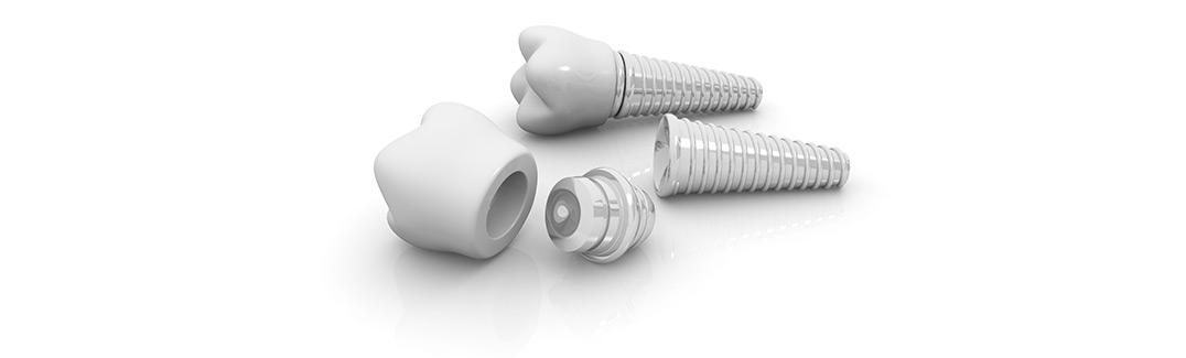 Dental implants