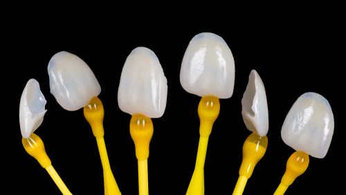 porcelain veneers