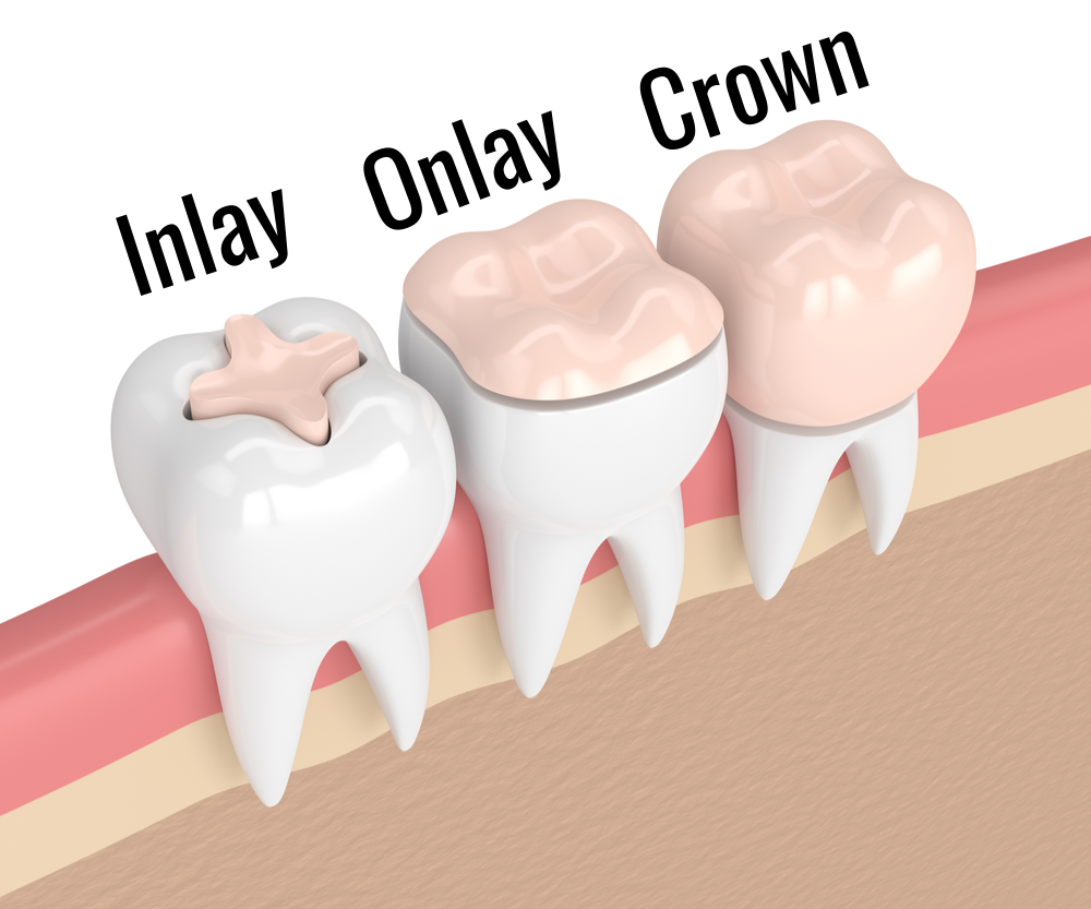 3D render of a dental inlay, onlay, and crown