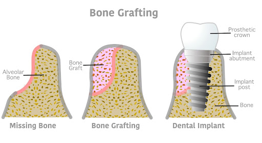 “bone grafting for dental implants