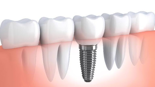 single-tooth dental implant