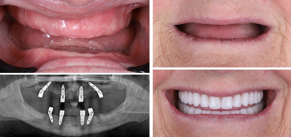 patient smile restored with all-on-4