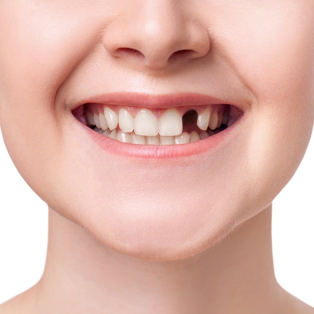 missing tooth