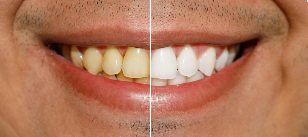 teeth whitening before and after