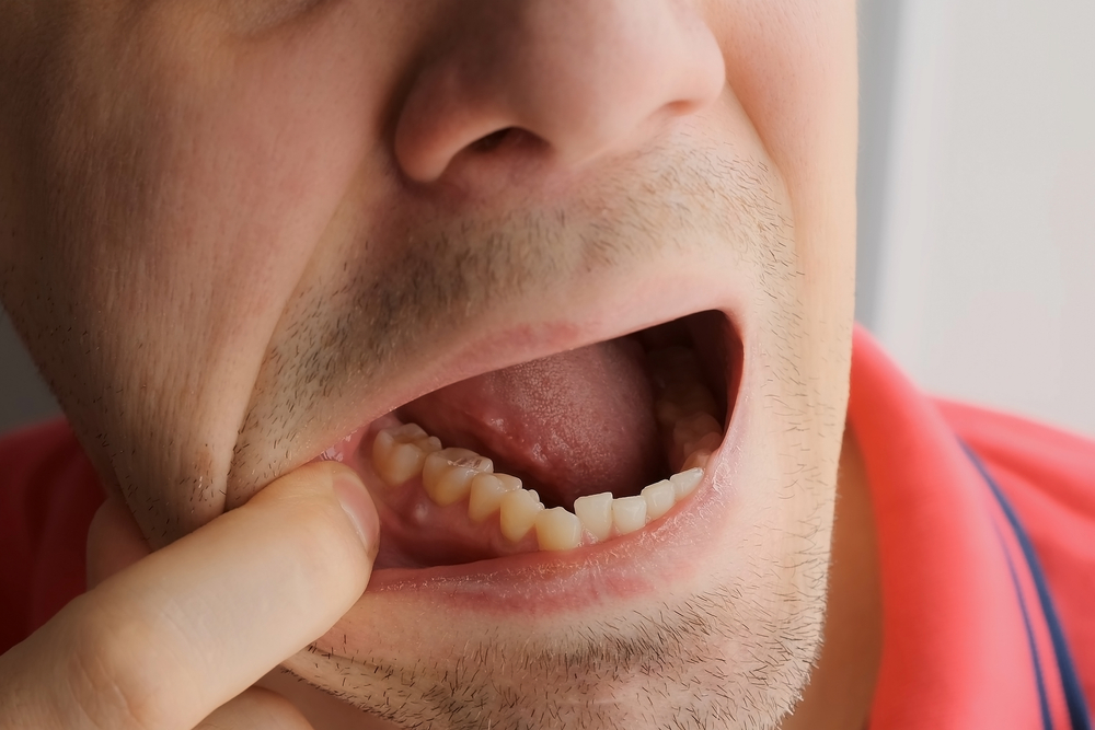 dental abscess