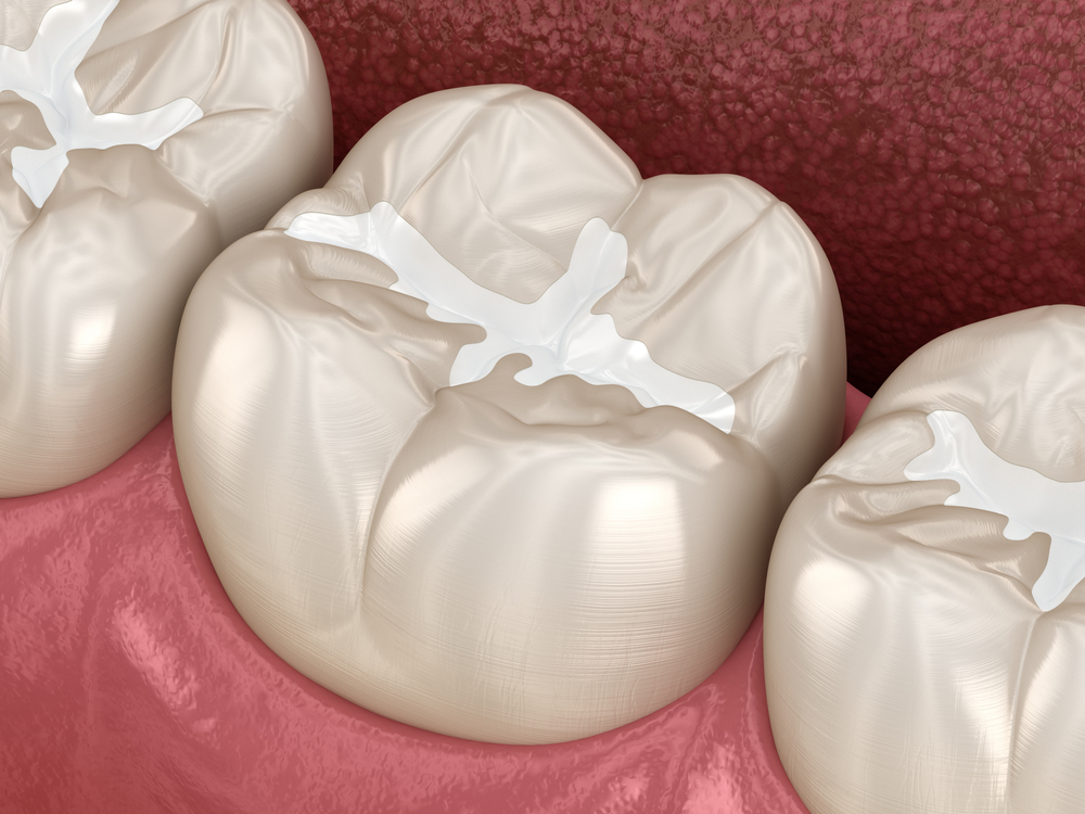 dental sealant