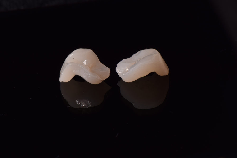 partial dental restorations